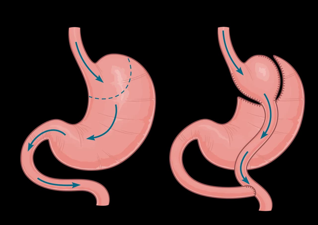 Operacja sleeve to Twoja droga do trwałej redukcji masy ciała?