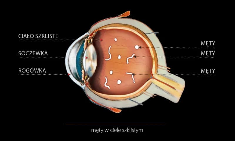 Męty w oku - jak je usunąć i zapobiec ich powstawaniu? Skuteczne metody leczenia.