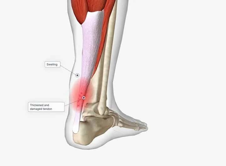 Budowa, elementy i zastosowanie stawów skokowych - górnego i dolnego