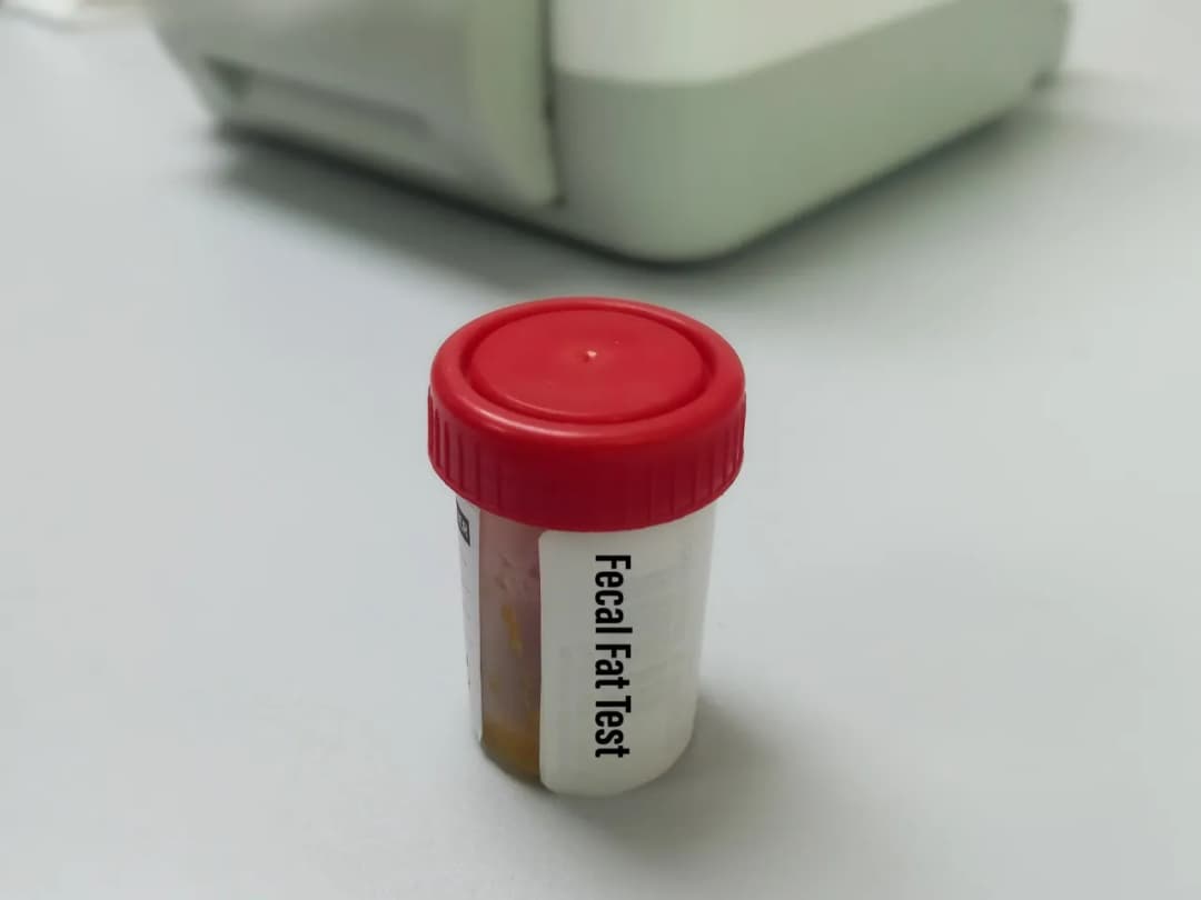 Tłuszczowe biegunki? Oto ukryte przyczyny, które Cię zszokują!